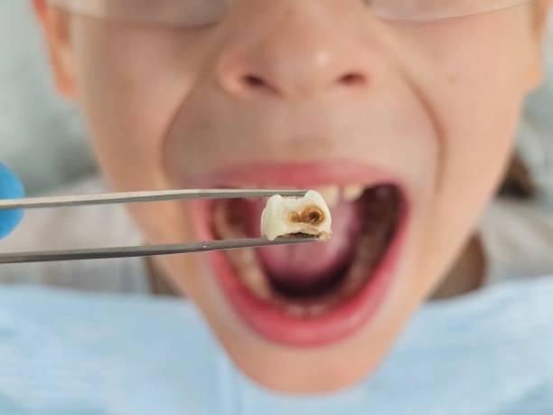 Best Emergency Dentist for Lost Fillings or Crowns in Kingstown, MD
